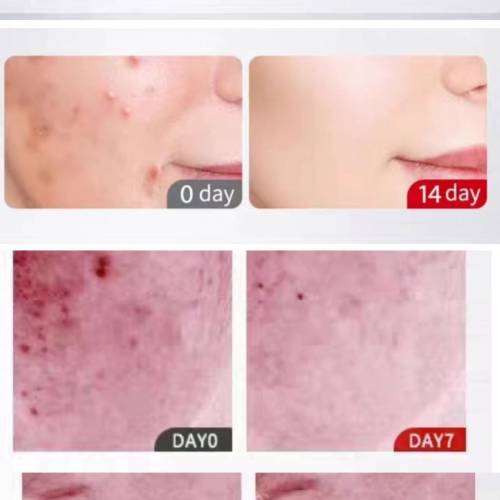 新加坡水楊酸去痘收毛孔粉刺煥采精華液    30ML