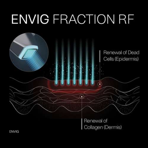 全球首創以色列醫美專家研發的ENVIG EDGE by Tripollar隔空無創微針射頻儀 提拉緊緻...