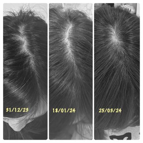 男女岩用❗️一套3件SDEEN育髮生髮套裝 最快2️⃣星期見效 3位數產品拯救7年脫髮問題