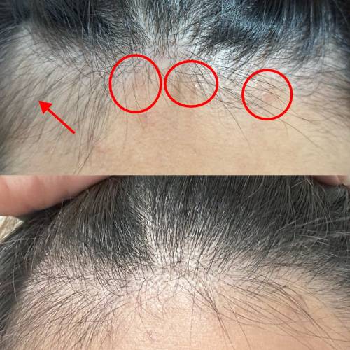 男女岩用❗️一套3件SDEEN育髮生髮套裝 最快2️⃣星期見效 3位數產品拯救7年脫髮問題