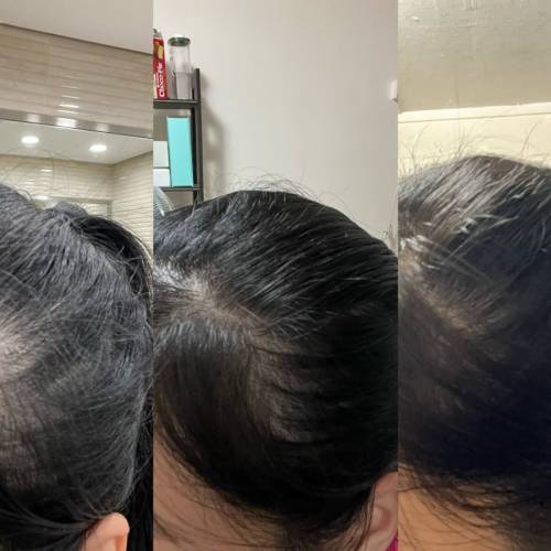 男女岩用❗️一套3件SDEEN育髮生髮套裝 最快2️⃣星期見效 3位數產品拯救7年脫髮問題