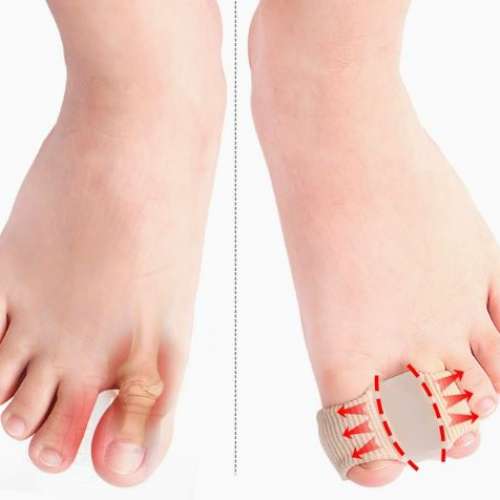 全新 矽膠 拇指外翻墊 腳趾矯形套 腳趾分趾墊 S碼 L碼