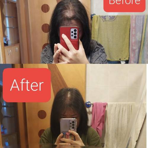 桂圓美生髮注氧注藥儀 及 附送配件